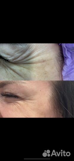 Косметолг Ботокс /бьютификация /липолитики