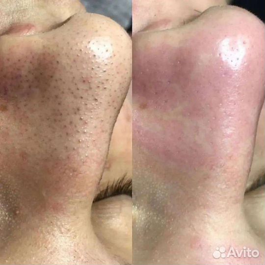 Косметолог чистка лица уз + механическая + пилинг