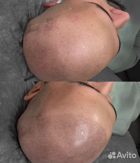 Трихопигментация SMP в Санкт-Петербурге