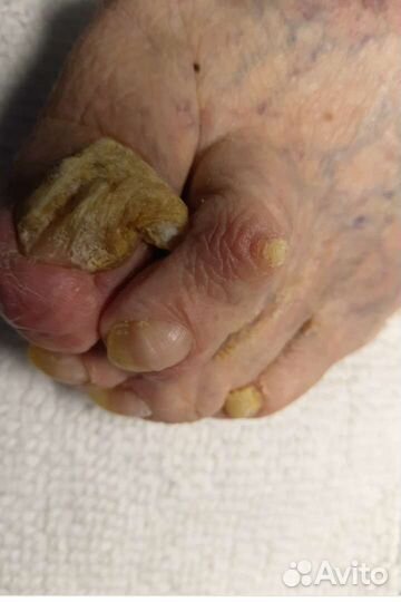 Парамедицинский педикюр подолог