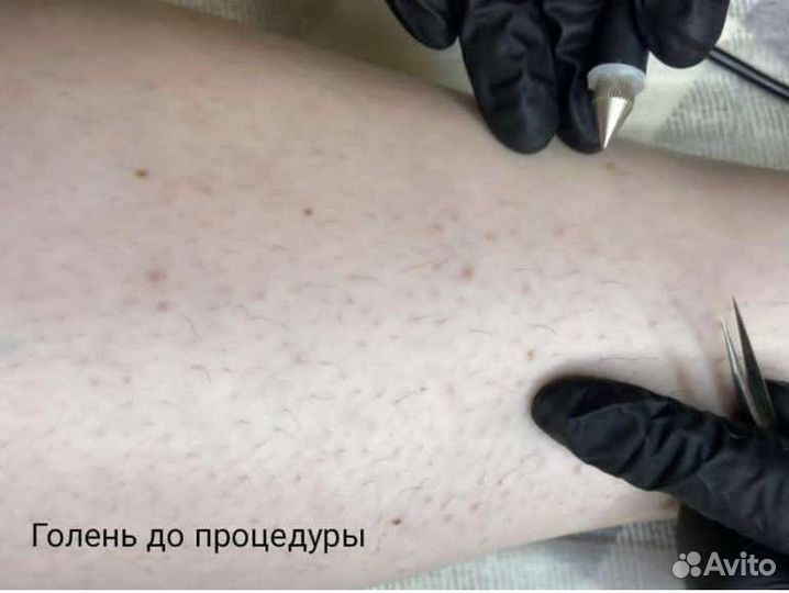 Электроэпиляция, удаление волос навсегда