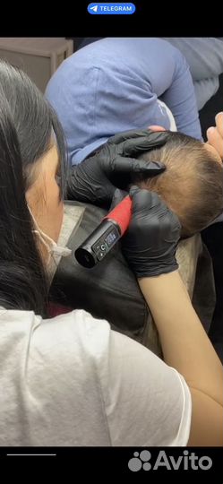 Трихопигментация SMP головы