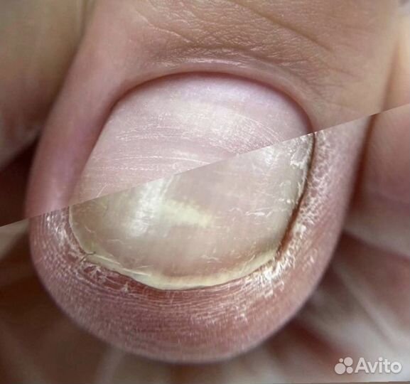 Подология Педикюр Маникюр Вросшие ногти Мазоли