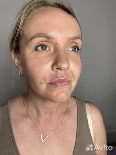 Увеличение губ