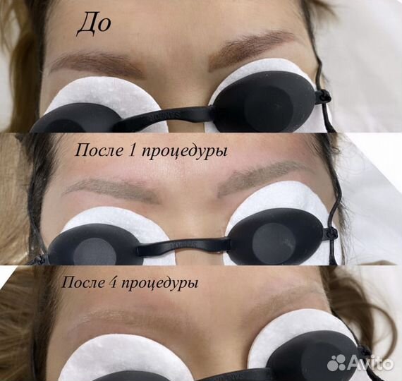 Лазерное удаление тату и татуажа