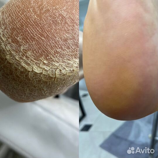 Подолог. Лечебный педикюр. Без боли