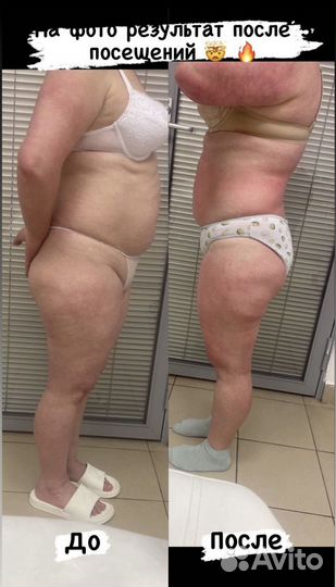 Аппаратный лимфодренажный массаж