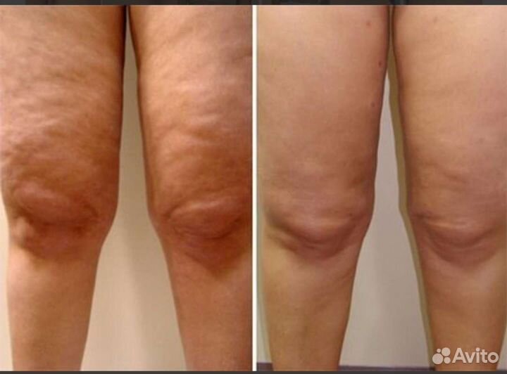 Вакуумный РФ лифтинг. Акция всего