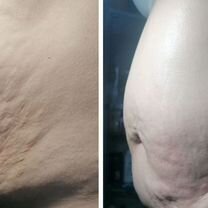 Похудение без диет криолиполиз Зеленоград, Зеленоград