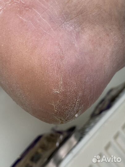 Подолог Сочи с выездом на дом