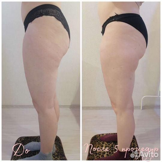 Шугаринг (депиляция), массаж лица и тела