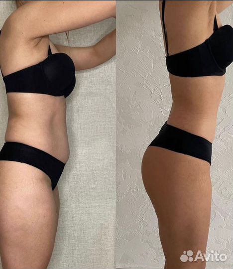 Коррекция фигуры, антицеллюлитный массаж, массаж