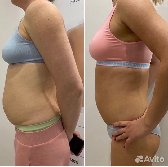 Криолиполиз липосакция без операции