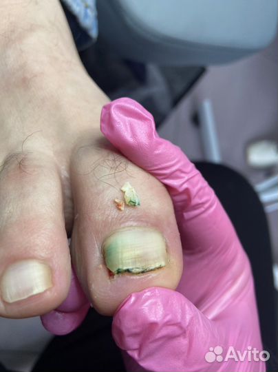 Подолог Елец Медицинский педикюр