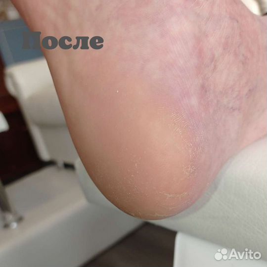 Педикюр, парамедицинский педикюр