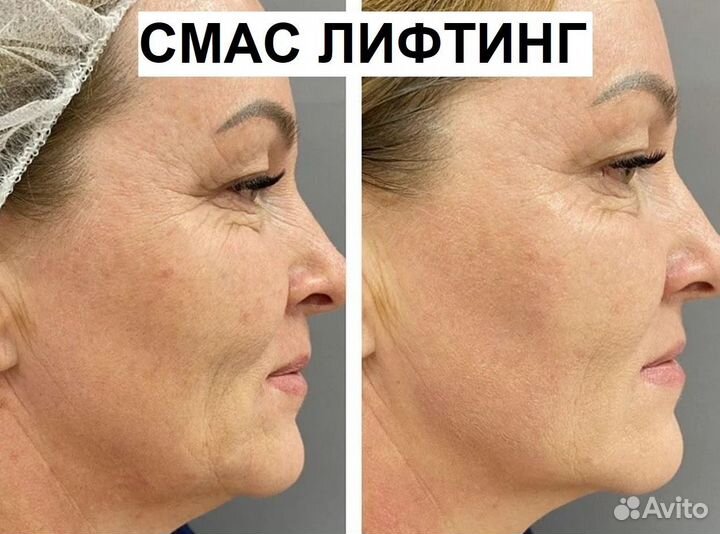 Лифтинг эффект