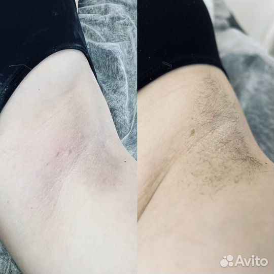 Шугаринг/ Воск