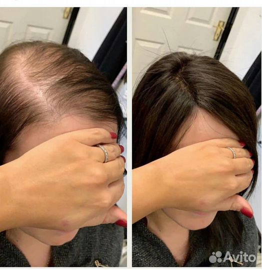 Накладка из натуральных волос на теменную зону