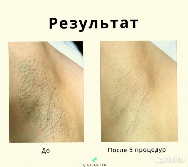 Диодный лазер Люминес Макс Ван 1200вт