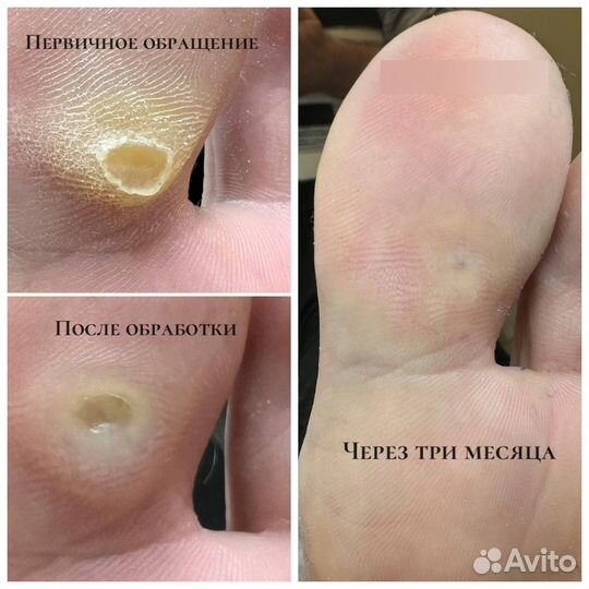 Подология / медицинский педикюр / SMART педикюр