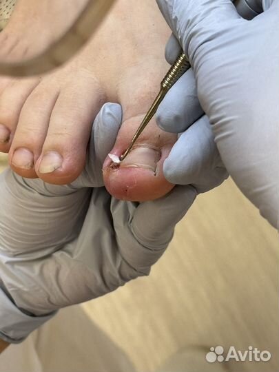 Вросший ноготь