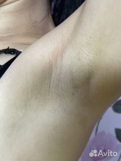 Лазерная эпиляция