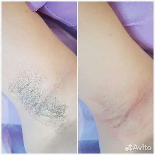 Шугаринг: глубокое бикини