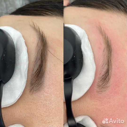 Удаление перманентного макияжа татуажа татуировок