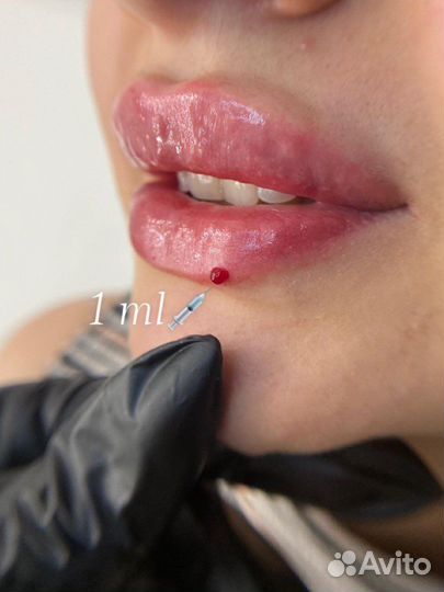 Косметолог. Увеличение губ. Ботокс