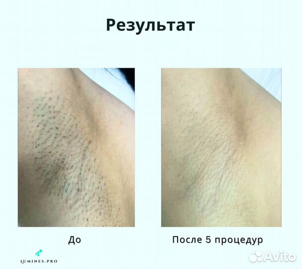 Диодный лазер для эпиляции Люминес. Эво-Про 2400вт