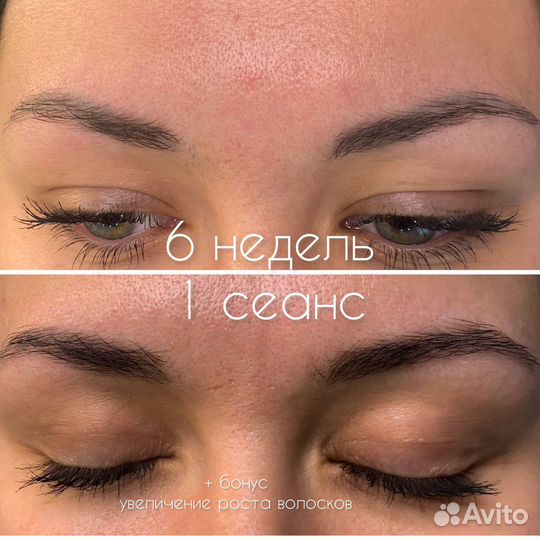 Лазерное удаление татуажа/тату. Карбоновый пилинг