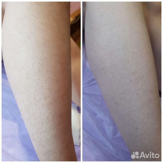 Шугаринг: глубокое бикини