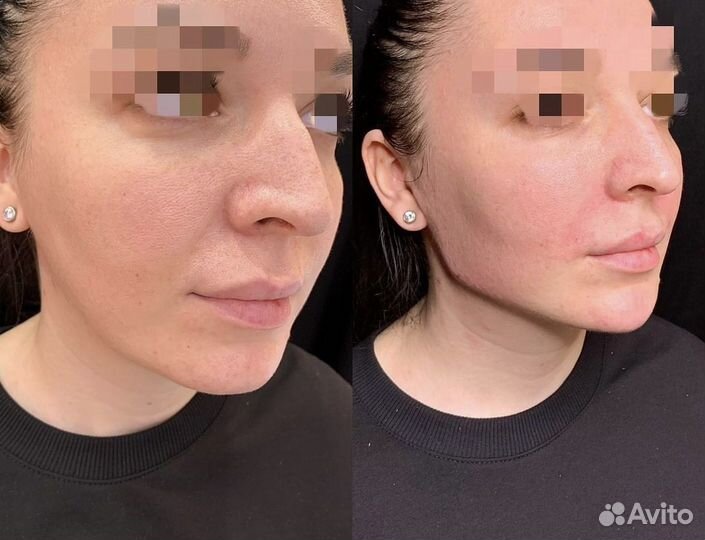 Лицо под ключ Full Face гармонизация обучение