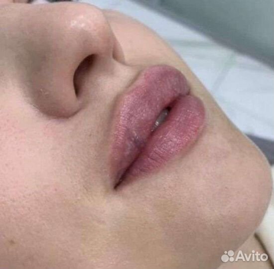 Контурная пластика