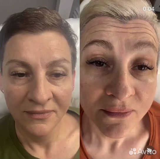 Ботокс (ботулинотерапия)