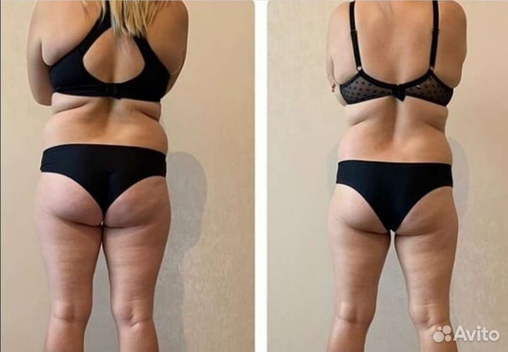 Антицеллюлитный массаж. Кавитация.RF-лифтинг