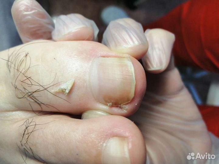 Подолог. Педикюр лечебный /мужской /женский/детски