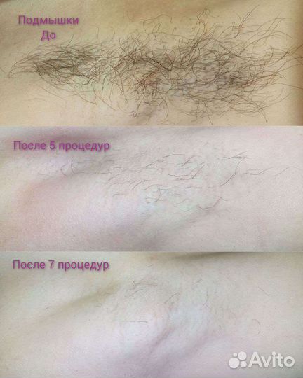 Электроэпиляция