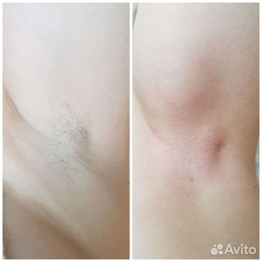 Шугаринг: глубокое бикини