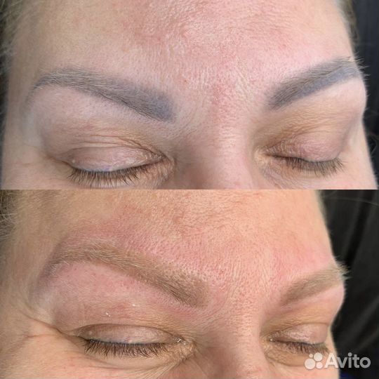 Лазерное удаление татуажа, перманента, тату