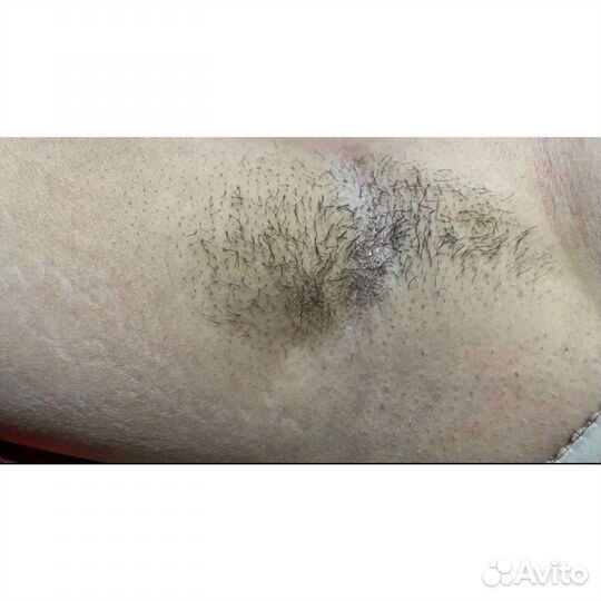 Шугаринг женский /мужской