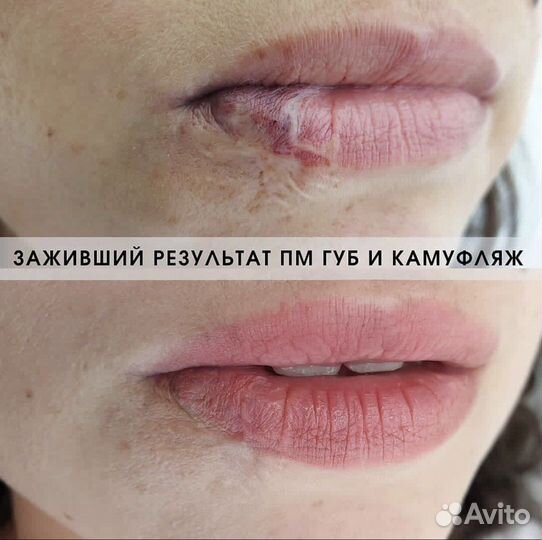 Камуфляж шрамов