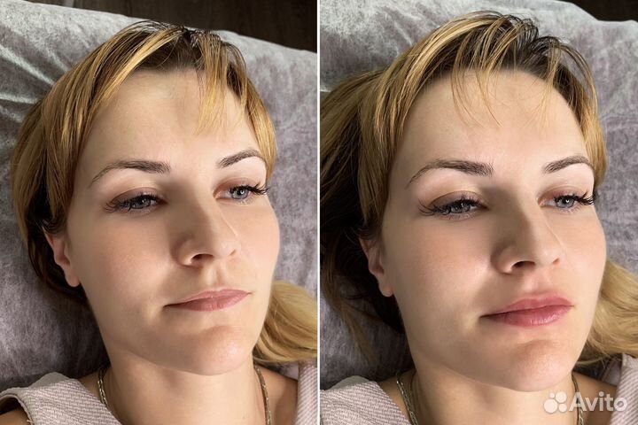 Увеличение губ аппаратом без боли