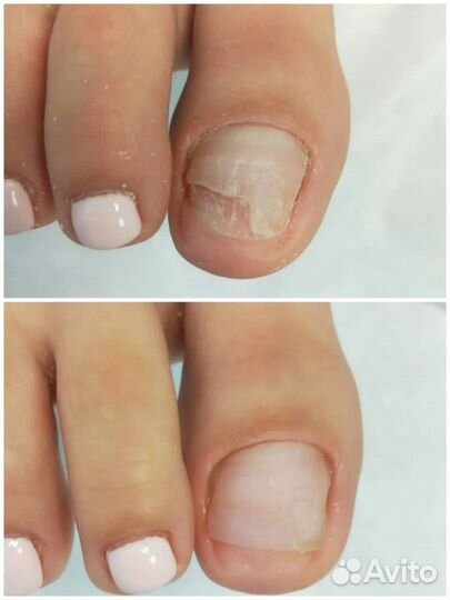 Услуги подолога, педикюр