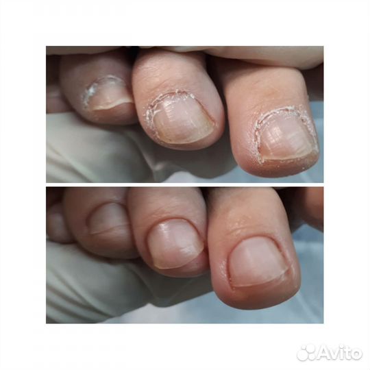 Педикюр(работа со сложной стопой)