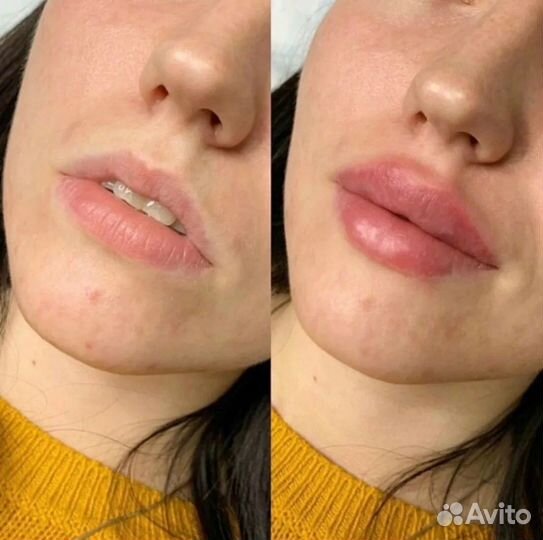 Модель на увеличение губ