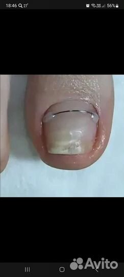 Коррекция вросшего ногтя