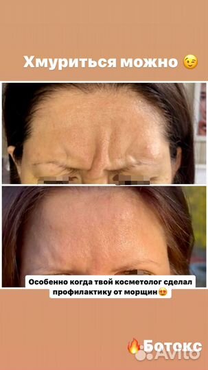 Ботокс