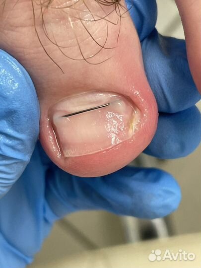 Подолог с выездом на дом