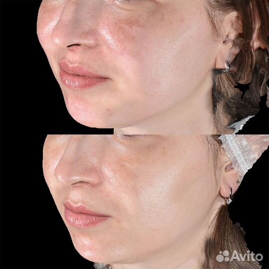 Аппаратная косметология без реабилитации